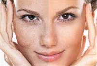 Hyperpigmentation Face & Acne Treatment image 7